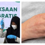 Kemenkes Giat Percepatan Eliminasi Kusta dalam Program Cek Kesehatan Gratis 2026