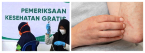 Kemenkes Giat Percepatan Eliminasi Kusta dalam Program Cek Kesehatan Gratis 2026