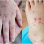 Waspada Wabah Campak, Kemenkes: Ada Peningkatan Kasus Sepanjang Tahun 2025 hingga Awal 2026.