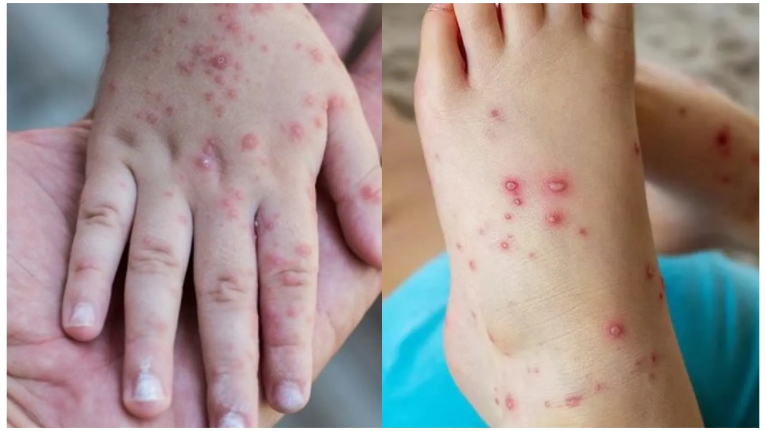 Waspada Wabah Campak, Kemenkes: Ada Peningkatan Kasus Sepanjang Tahun 2025 hingga Awal 2026.