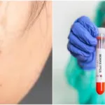 Mengenal 3 Jenis Cacar,  Cacar Air, Cacar Monyet dan Cacar Api, Penyebaran dan Perbedaannya