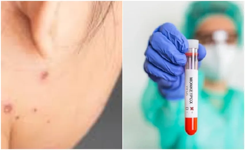 Mengenal 3 Jenis Cacar,  Cacar Air, Cacar Monyet dan Cacar Api, Penyebaran dan Perbedaannya