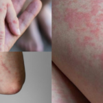 Menurut WHO Satu Virus Campak Beresiko Menular Ke 18 Orang lain