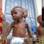 Mengenal Gizi Buruk dan Upaya Pencegahan dan Penanganan Di Indonesia