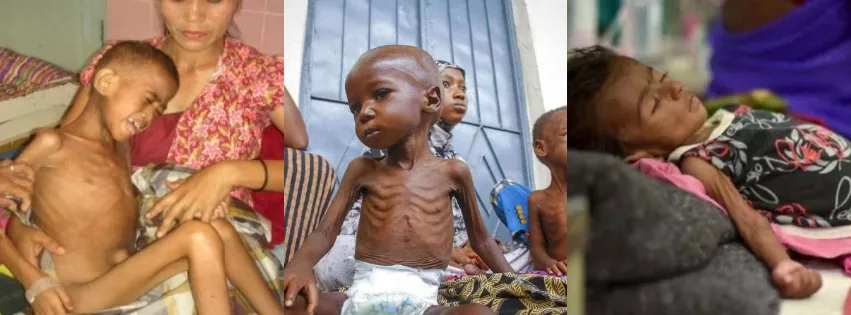 Mengenal Gizi Buruk dan Upaya Pencegahan dan Penanganan Di Indonesia