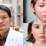 Awas Tertipu! Ini Cara Mengenal 3 Gejala Awal Campak