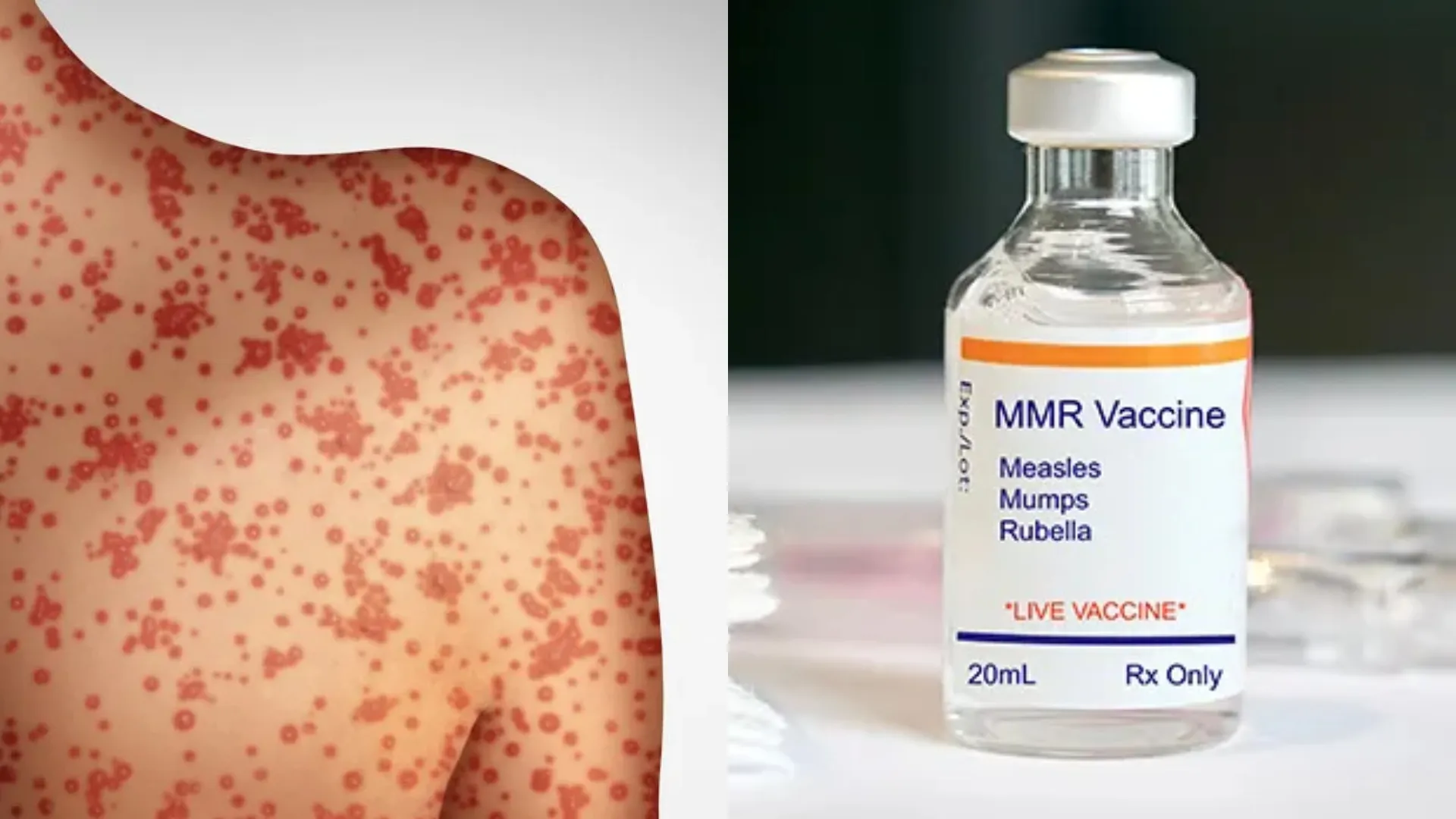 Resiko Penularan Campak Masyarakat Diimbau Memanfaatkan Imunisasi, Ketua IDAI: Itu Bukan Penyakit Sepele